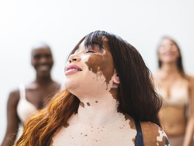 Vitiligo, maladie dermatologique causant la depigmentation du visage